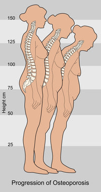 Progression of Osteoporosis Poster Print by Gwen Shockey showing stages of bone health.