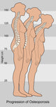 Progression of Osteoporosis Poster Print by Gwen Shockey showing stages of bone health.