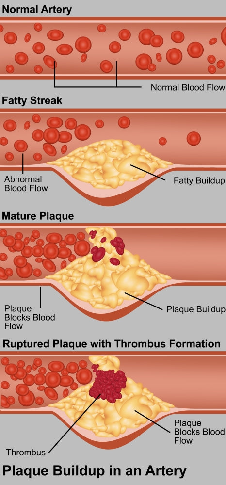 Plaque in Artery scientific poster print showing detailed artery structure.