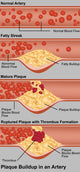 Plaque in Artery scientific poster print showing detailed artery structure.