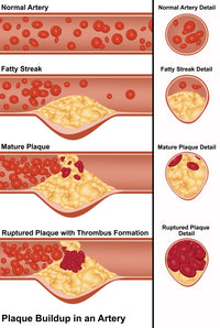 Plaque in Artery Poster Print showcasing detailed human anatomy.
