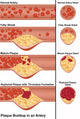Plaque in Artery Poster Print showcasing detailed human anatomy.