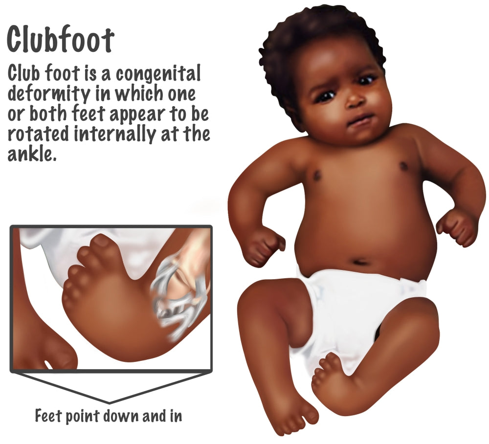 Baby with Club Foot Poster Print by Gwen Shockey - Educational Art