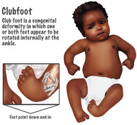 Baby with Club Foot Poster Print by Gwen Shockey - Educational Art