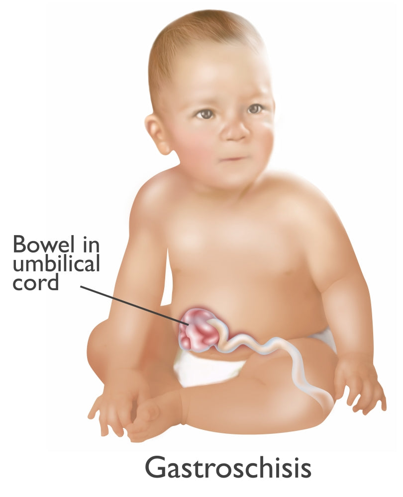 Baby with Gastroschisis educational poster print by Gwen Shockey