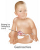 Baby with Gastroschisis educational poster print by Gwen Shockey