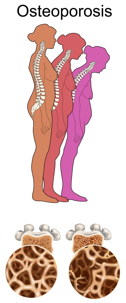 Osteoporosis educational poster print by Gwen Shockey, showcasing vital information on bone health.