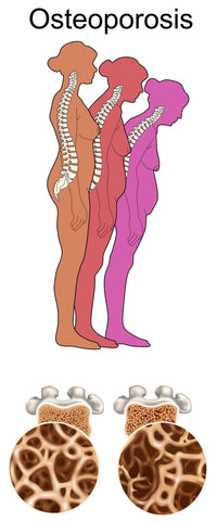 Osteoporosis educational poster print by Gwen Shockey, showcasing vital information on bone health.
