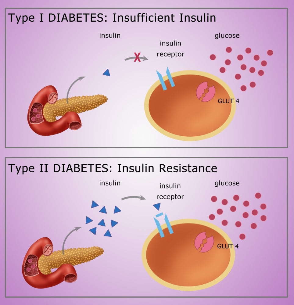 Diabetes I & II Educational Poster Print by Monica Schroeder