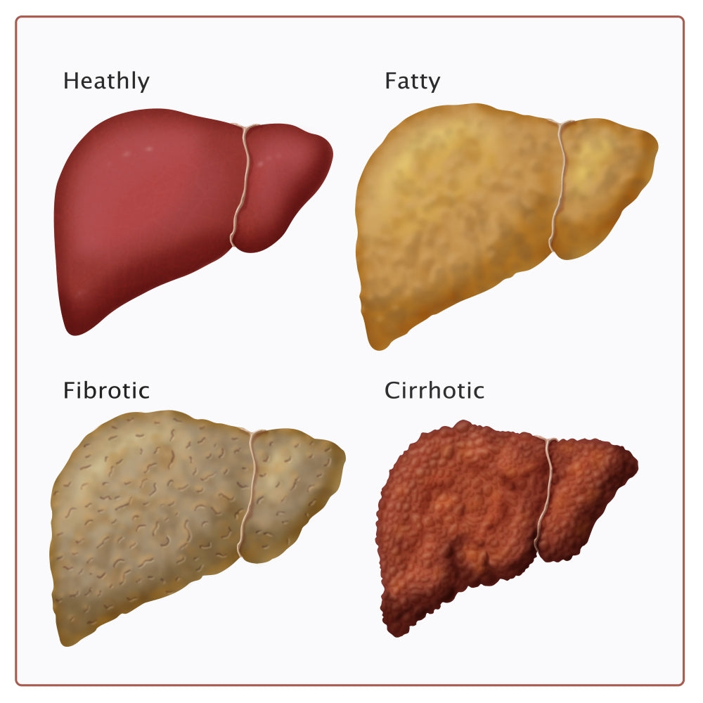 Stages of Liver Damage educational poster print by Monica Schroeder.