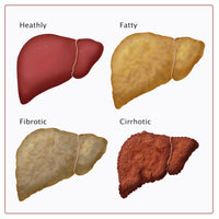 Stages of Liver Damage educational poster print by Monica Schroeder.