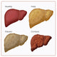 Stages of Liver Damage educational poster print by Monica Schroeder.