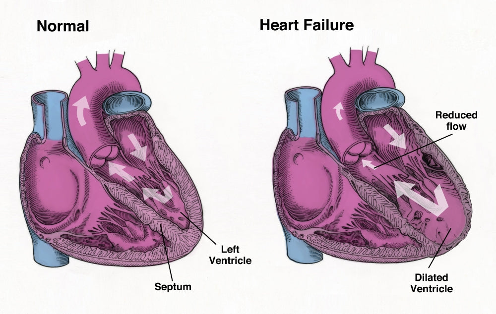 Healthy Heart vs. Heart Failure Educational Poster Print by Spencer Sutton