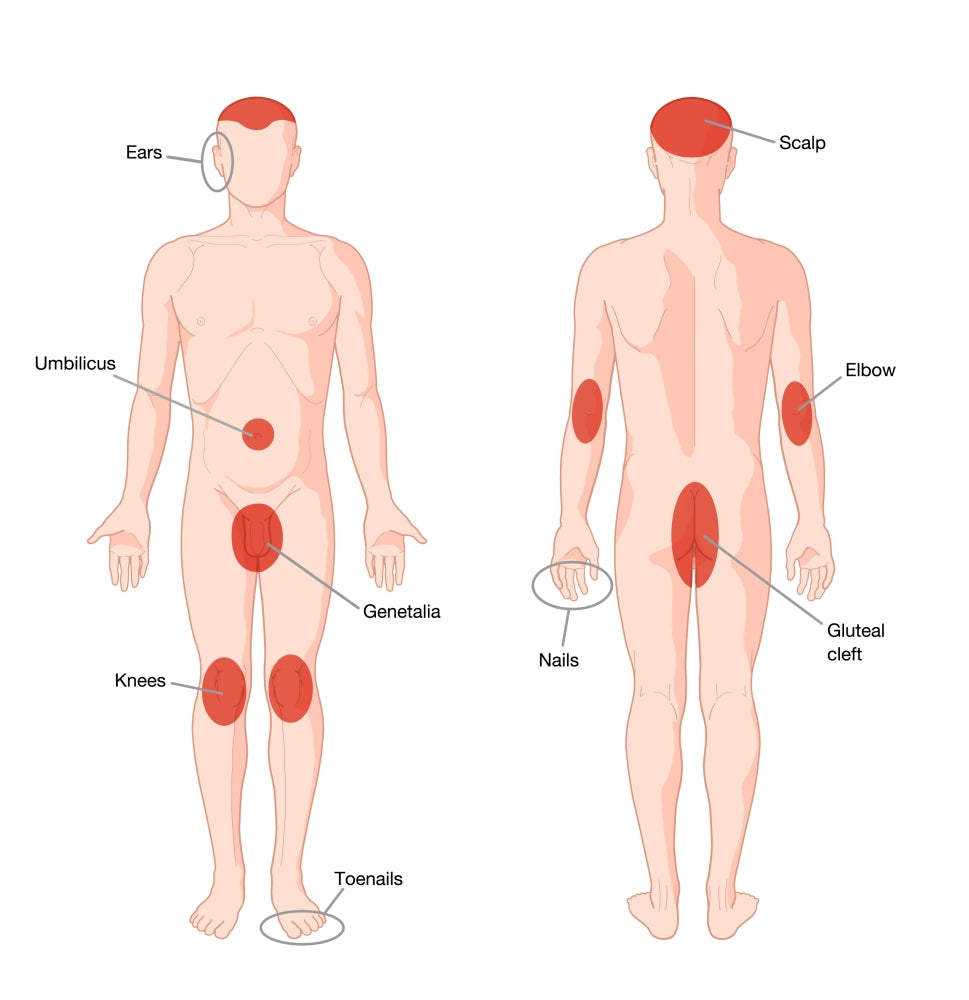 Areas of the Body Affected by Psoriasis Poster Print showcasing affected skin regions.