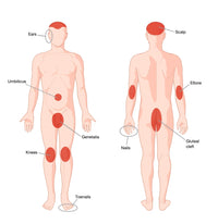Areas of the Body Affected by Psoriasis Poster Print showcasing affected skin regions.