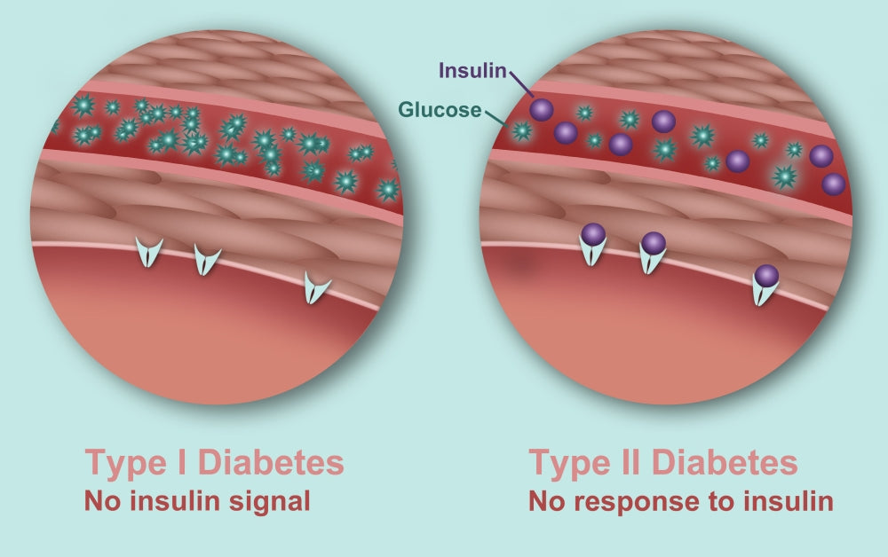 Type 1 and Type 2 Diabetes Educational Poster Print by Gwen Shockey