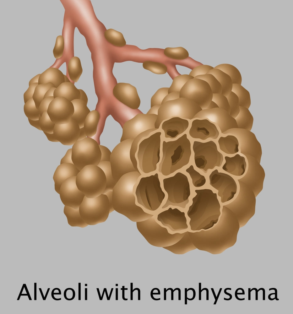 Alveoli with Emphysema Science Poster Print by Gwen Shockey