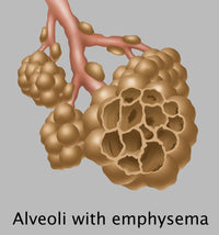 Alveoli with Emphysema Science Poster Print by Gwen Shockey