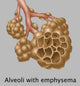 Alveoli with Emphysema Science Poster Print by Gwen Shockey