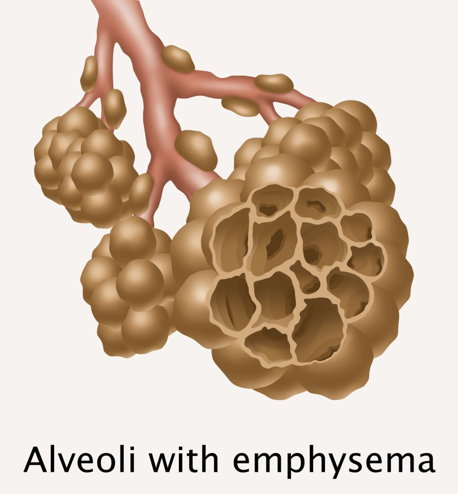 Alveoli with Emphysema Poster Print illustrating respiratory health.