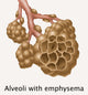 Alveoli with Emphysema Poster Print illustrating respiratory health.