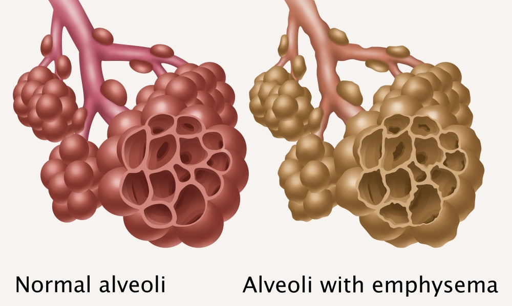 Normal vs. Emphysematous Alveoli Poster Print for educational purposes.