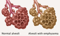 Normal vs. Emphysematous Alveoli Poster Print for educational purposes.