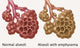 Normal vs. Emphysematous Alveoli Poster Print for educational purposes.
