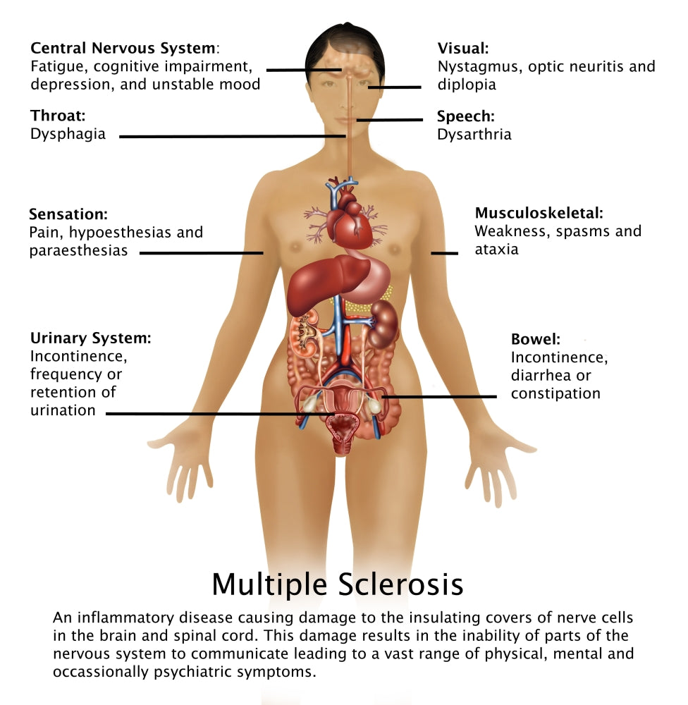 Symptoms of Multiple Sclerosis Poster Print educational artwork.