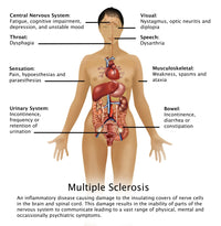 Symptoms of Multiple Sclerosis Poster Print educational artwork.