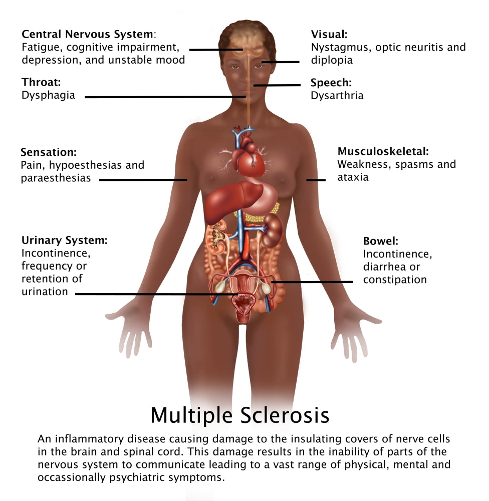 Symptoms of Multiple Sclerosis Poster Print featuring educational graphics