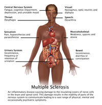 Symptoms of Multiple Sclerosis Poster Print featuring educational graphics