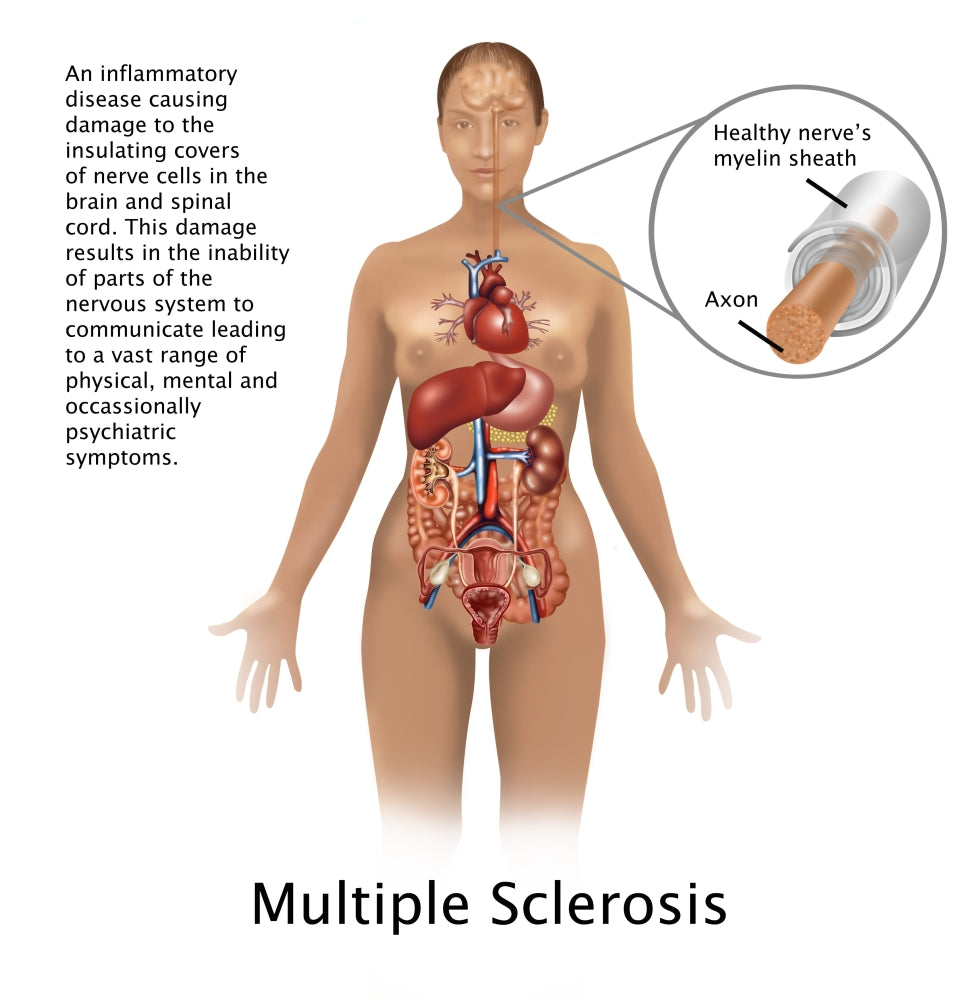 Multiple Sclerosis and Nerves Poster Print by Science Source, educational artwork