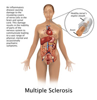 Multiple Sclerosis and Nerves Poster Print by Science Source, educational artwork