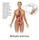 Multiple Sclerosis and Nerves Poster Print by Science Source, educational artwork