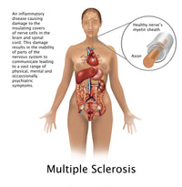 Multiple Sclerosis and Nerves Poster Print by Gwen Shockey