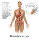 Multiple Sclerosis and Nerves Poster Print by Gwen Shockey