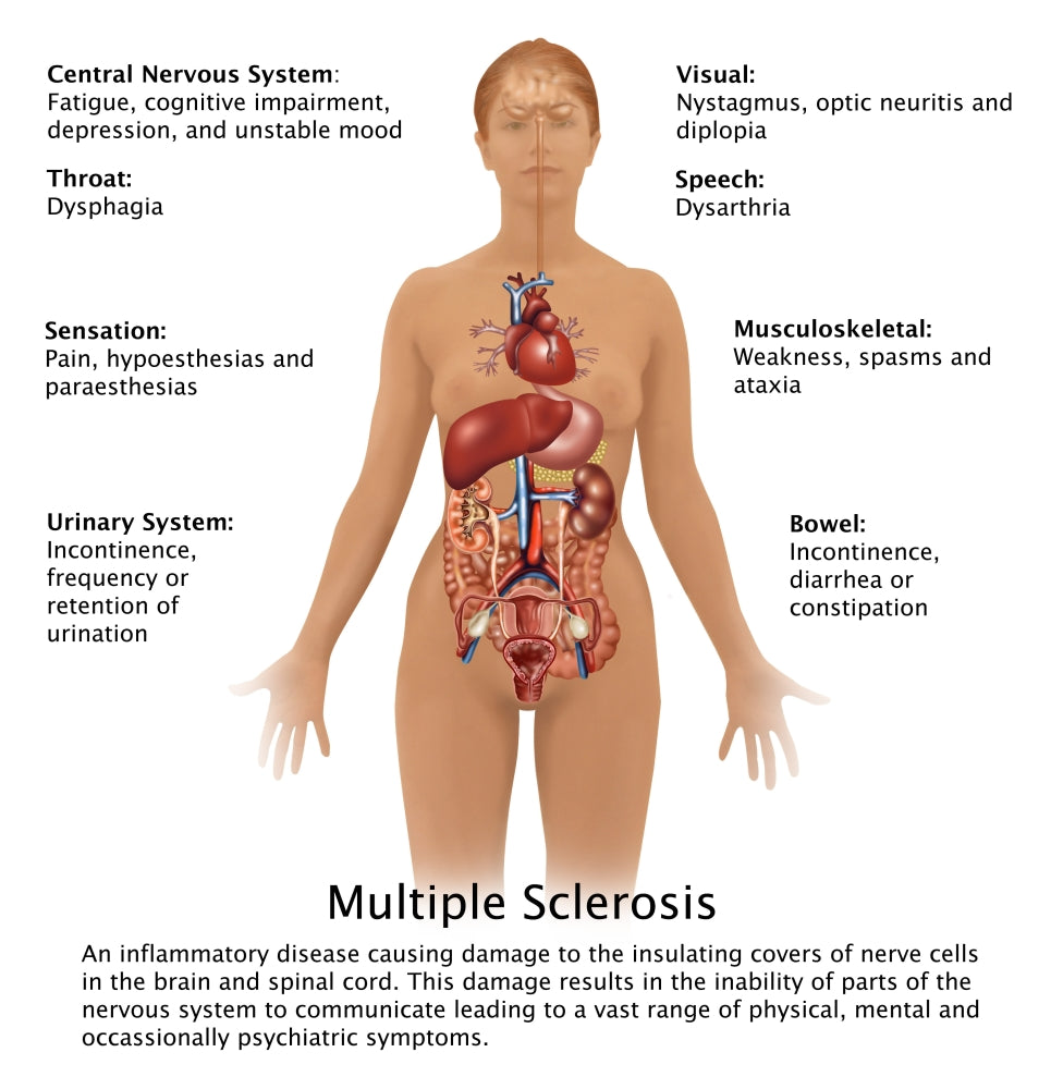 Symptoms of Multiple Sclerosis Educational Poster Print by Gwen Shockey