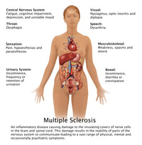 Symptoms of Multiple Sclerosis Educational Poster Print by Gwen Shockey