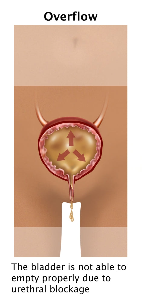 Overflow Incontinence Poster Print by Gwen Shockey, educational art for anatomy and health.