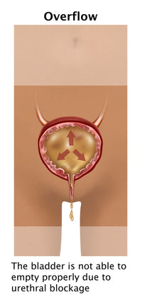 Overflow Incontinence Poster Print by Gwen Shockey, educational art for anatomy and health.