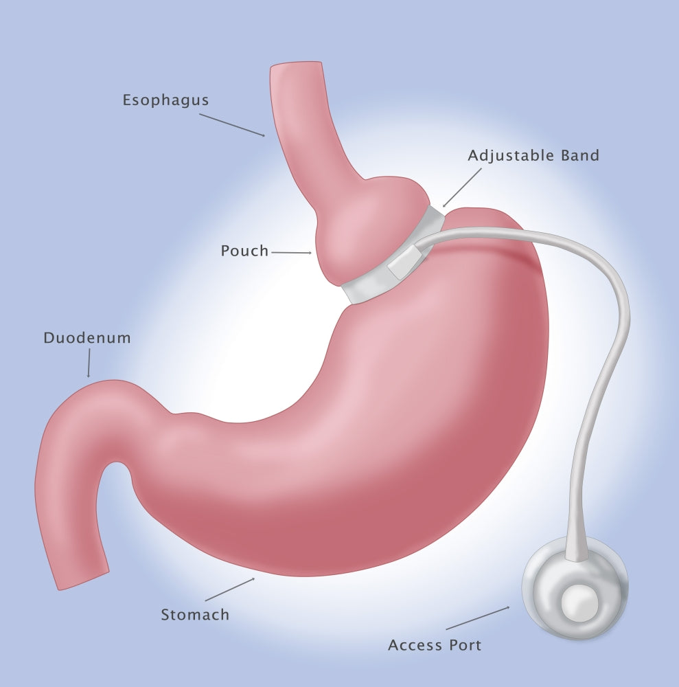 Adjustable Gastric Band Medical Poster Print by Monica Schroeder