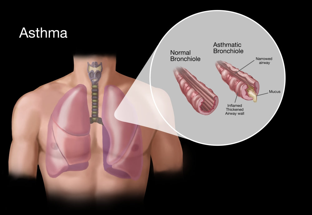 Asthma and Bronchioles Educational Poster Print