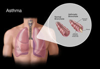 Asthma and Bronchioles Educational Poster Print