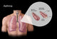 Asthma and Bronchioles Educational Poster Print