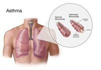 Asthma and Bronchioles Educational Poster Print by Spencer Sutton