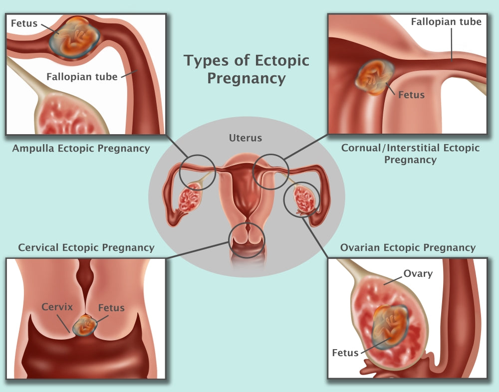 Ectopic Pregnancy Educational Poster Print by Gwen Shockey