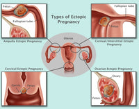 Ectopic Pregnancy Educational Poster Print by Gwen Shockey