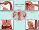 Ectopic Pregnancy Educational Poster Print by Gwen Shockey