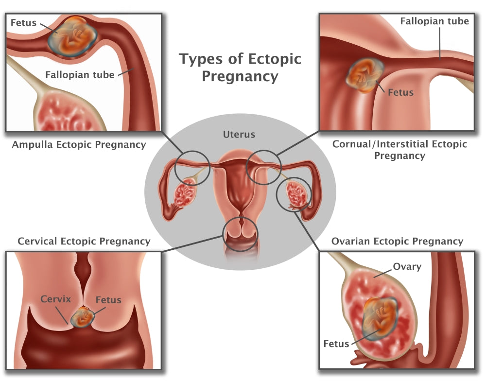 Ectopic Pregnancy Educational Poster Print by Science Source